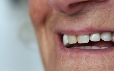 The Silent Epidemic of Hidden Decay in Women Over 40