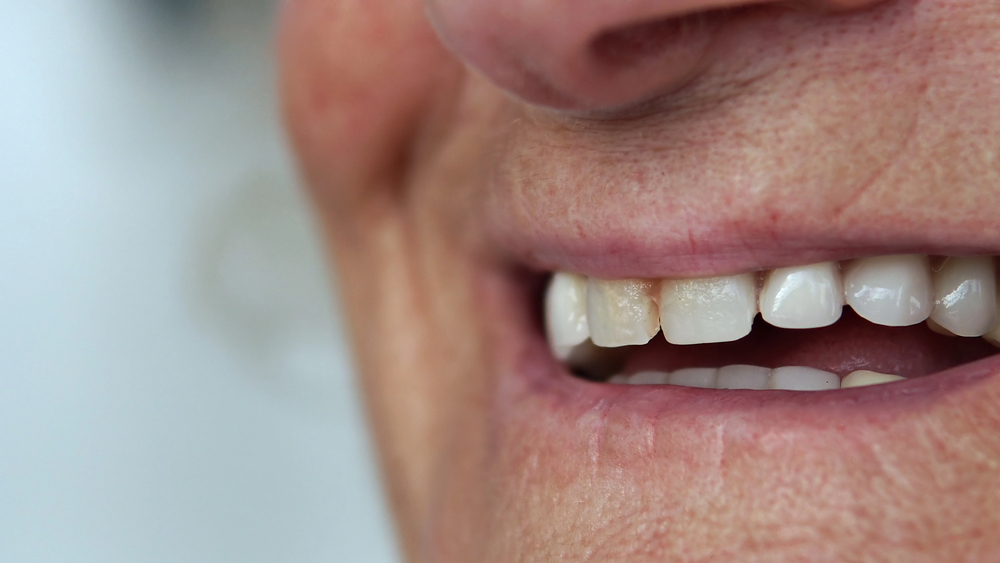The Silent Epidemic of Hidden Decay in Women Over 40